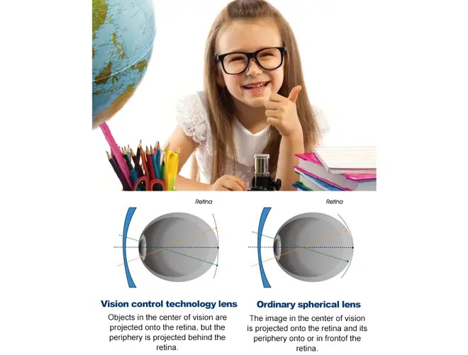 /uploads/image/2025/09/09/myovision-lens-2.jpg myovision-lens-2.jpg
