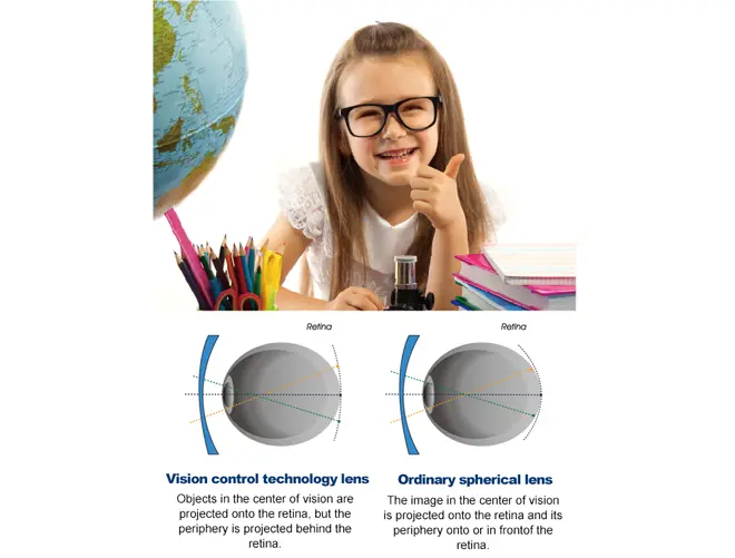 Specifiche della lente monofocale per il controllo della miopia con defocus periferico per bambini